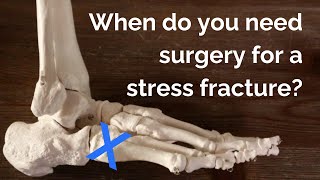 Stress Fracture Surgery What You Need to Know [upl. by Montano]