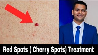 Red Skin Dots  cherry Angioma  Natural Treatment  Dr Vivek Joshi [upl. by Tesler]