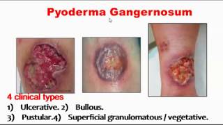 Pyoderma gangernosum [upl. by Hanover]