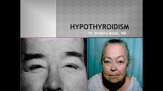 Hypothyroidism Myxedema [upl. by Mazurek]