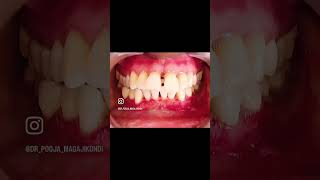 Periodontist gums depigmentation gingivaldepigmentation scalpel blackgums esthetics smile [upl. by Harak48]