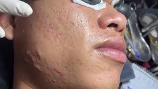 Acne Treatment Huong Da Nang601  2024 blackheads [upl. by Ronnie568]