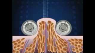 How Endermologie® works lipomassage [upl. by Walworth137]