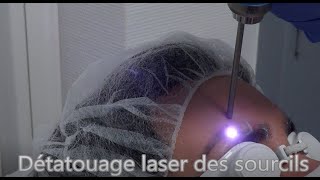 Détatouage laser des sourcils sans douleur technique simple et rapide avec une machine performante [upl. by Letitia]