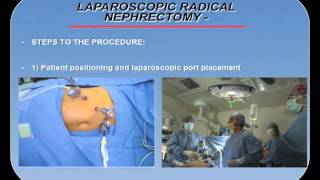 LAPAROSCOPIC RADICAL NEPHRECTOMY PROCEDURE OVERVIEW [upl. by Leelaj503]