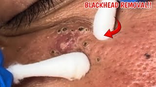 Blackhead removalAcne treatment from DR NOPRIZAL 6 [upl. by Loreen]