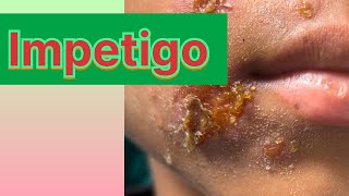 Impetigo in childrenबच्चो में होने बाले फोड़े फ़िन्सी [upl. by Kallick28]