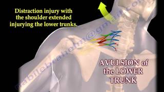 Brachial Plexus Mechanism Of Injury  Everything You Need To Know  Dr Nabil Ebraheim [upl. by Grier]