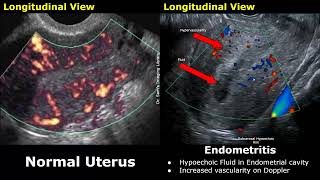 Uterus amp Adnexa Ultrasound Normal Vs Pelvic Inflammatory Disease PID Images  Gynecological USG [upl. by Akelam]