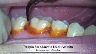 Terapia Parodontale Laser Assistita [upl. by Pascoe]