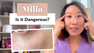 What Is Milia Removal and Prevention  Dermatologist Guide [upl. by Nadeau]