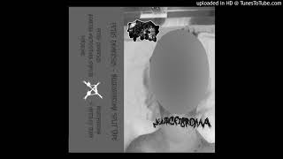 Fetus Demersus  Neurofibroma  Split Tape [upl. by Poll679]