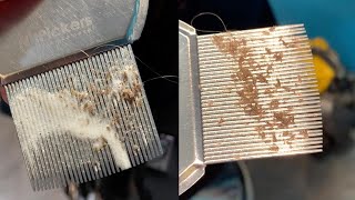 CloseUp Of Lice Infestation Removal [upl. by Llewellyn]