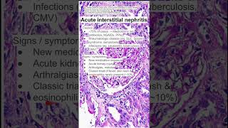 Acute interstitial nephritis [upl. by Anerehs]