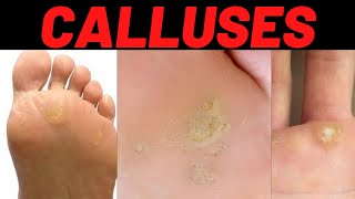 CALLUS Causes Symptoms Treatment Prevention [upl. by Aneerehs]