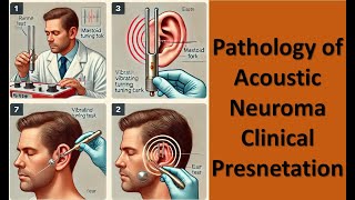 3 Pathology of Acoustic Neuroma Clinical Presnetation [upl. by Nyrehtac715]