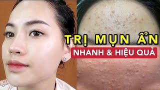 TRỊ MỤN ẨN MỤN ĐẦU ĐEN DA SẦN SÙI NHANH VÀ HIỆU QUẢ  DA TRƠN LÁNG CHỈ SAU 2 THÁNG [upl. by Derzon834]