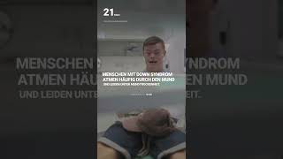 Trockener Mund bei Menschen mit Down Syndrom downsyndrom handicap tagderzahngesundheit [upl. by Homans]