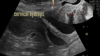 Cervical hydrops or Cervical fluid ultrasound and color Doppler [upl. by Enaols233]