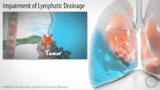 Pleural Space Part 3 of 3 Pleural Effusions HD [upl. by Shreeves]