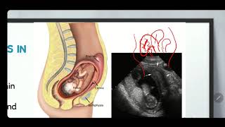 What is Retroverted Uterus  Uterine positions [upl. by Jempty]