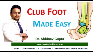 Congenital Talipes Equinovarus Varus CTEV  Club foot  Made easy with Dr Abhinav Gupta [upl. by Saraann]