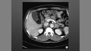 Suprarrenales Incidentaloma [upl. by Eneladgam]