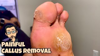 NEVER ENDING CALLUS REMOVAL FROM FEET [upl. by Agnesse]