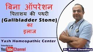 पित्ताशय की पथरी Gallbladder Stone का बिना ऑपरेशन के इलाज  Yash Homeopathic Center [upl. by Beard]