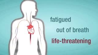 Valve Regurgitation When a Heart Valve Leaks [upl. by Kurman]