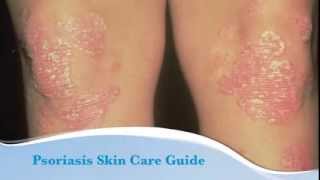 Psoriasis skin care guide [upl. by Zebulen677]