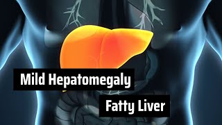 Fatty Liver with Mild Hepatomegaly  Causes Symptoms Diagnosis and Management [upl. by Drofnil]