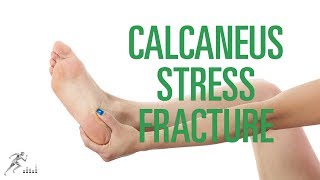 Calcaneus stress fracture Signs symptoms and treatment options [upl. by Nerw]