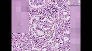 Histopathology LungAdenocarcinoma [upl. by Newby528]