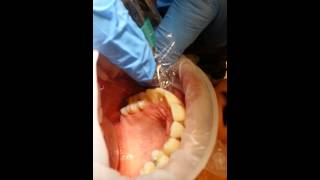 How To Needlefree dental injection by Dr Roslyn Skinner [upl. by Acimat]