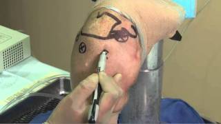 TAG Medical Arthroscopic Portal Placement for Arthroscopic Shoulder Surgery [upl. by Ahsiekam]