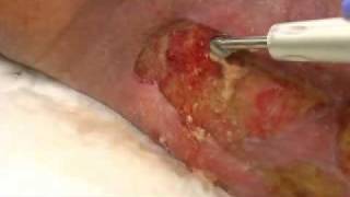 Demonstration Yellow slough removed via Qoustic Wound Therapy System [upl. by Naraj944]