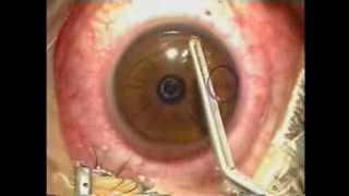 Lasik Laser Eye Surgery Procedure  Live Surgery [upl. by Vitkun183]