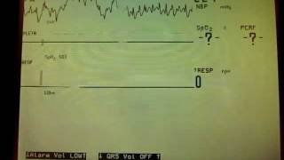 Asystole Apnea alarms [upl. by Oicaro]