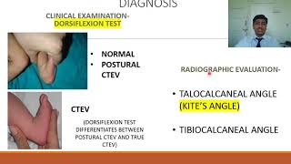 Congenital Talipes Equino Varus CTEV  Rapid Revision of Orthopaedics by Dr Prateek Joshi [upl. by Godrich]