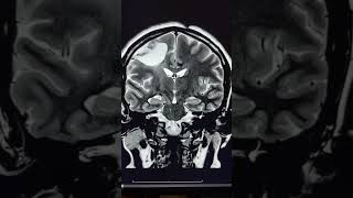 Wallerian degeneration of Corticospinal tract [upl. by Ahtennek]