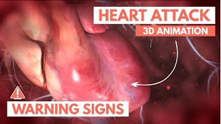 Recognizing a heart attack  3D Animation [upl. by Edith978]