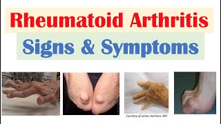 Rheumatoid Arthritis RA Signs amp Symptoms amp Associated Complications [upl. by Atinav]