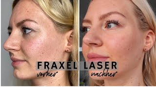 FRAXEL LASER BEHANDLUNG vorher nachher BilderVideos nach 2 Monaten [upl. by Nasah423]