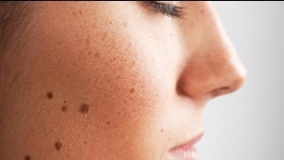 Signs of Skin Cancer [upl. by Walworth102]