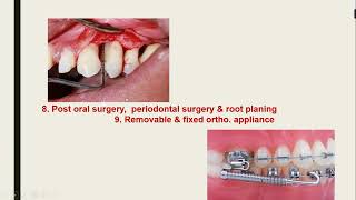 Chemotherapeutic agents in treatment of periodontal diseases DrAthraa Ali Alkutaishy [upl. by Dannye]