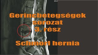 Gerincbetegségek sorozat 3 rész Schmorl hernia [upl. by Market727]