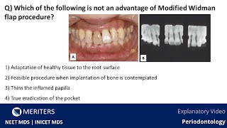 NEET MDS  INICET  Periodontology  Flap amp Mucogingival Surgery  Explanatory Video  MERITERS [upl. by Hoover2]