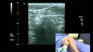 Popliteal Block Ultrasound guided  lateral approach [upl. by Laleb930]