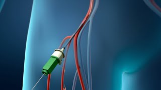 Coronary Angioplasty Femoral Access [upl. by Melina]